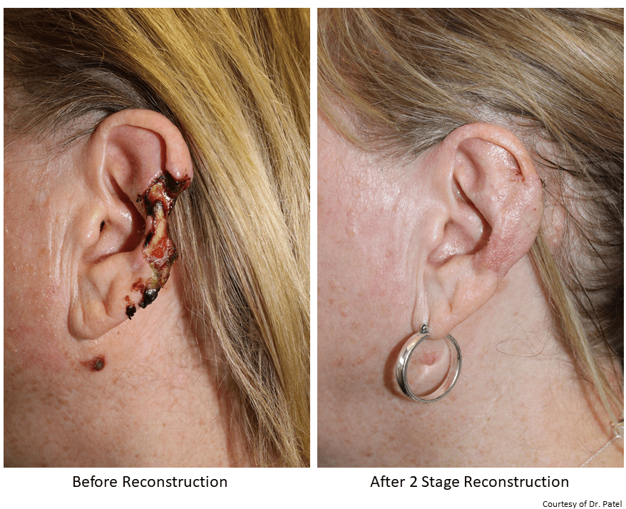 KT_ear-repair-sp-cancer-resection