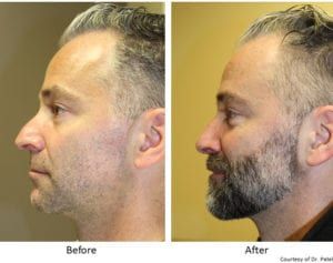 Rhinoplasty-Before-&-After--case-1-side
