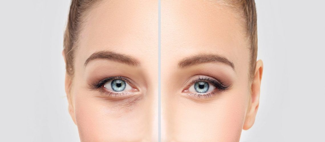 eyelid-surger-optimizedy